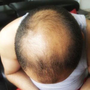 Scalp Micropigmentation Chicago